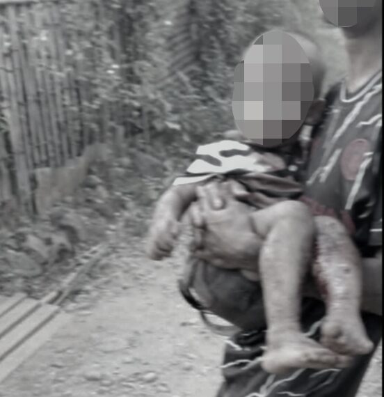 ကချင်ပြည်နယ် ဖားကန့်မြို့နယ်တွင် လေကြောင်းတိုက်ခိုက်မှုကြောင့် အရပ်သားများ ဒဏ်ရာရရှိ၊ ကလေးငယ်အပါအဝင်